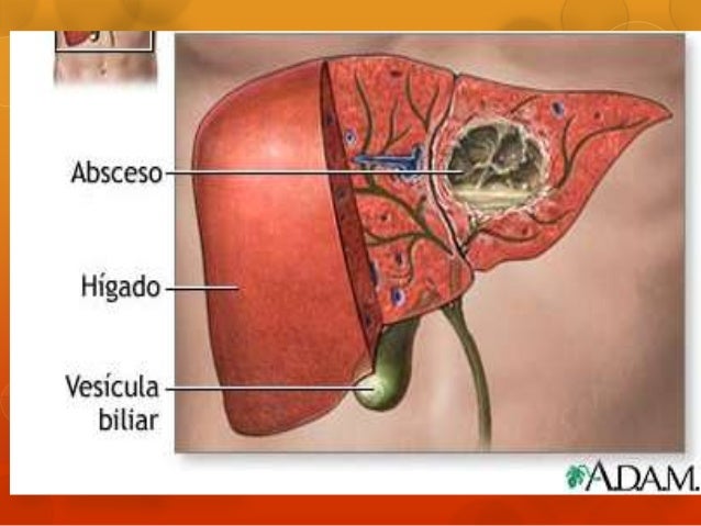 absceso hepatico amebiano